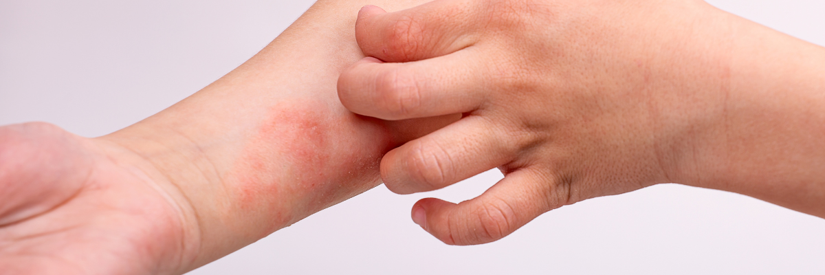 Eczema prone
