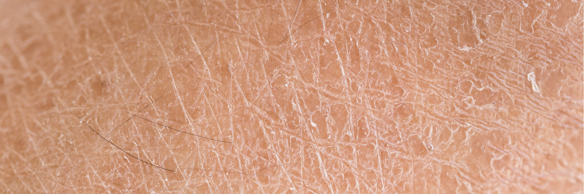 Dry skin