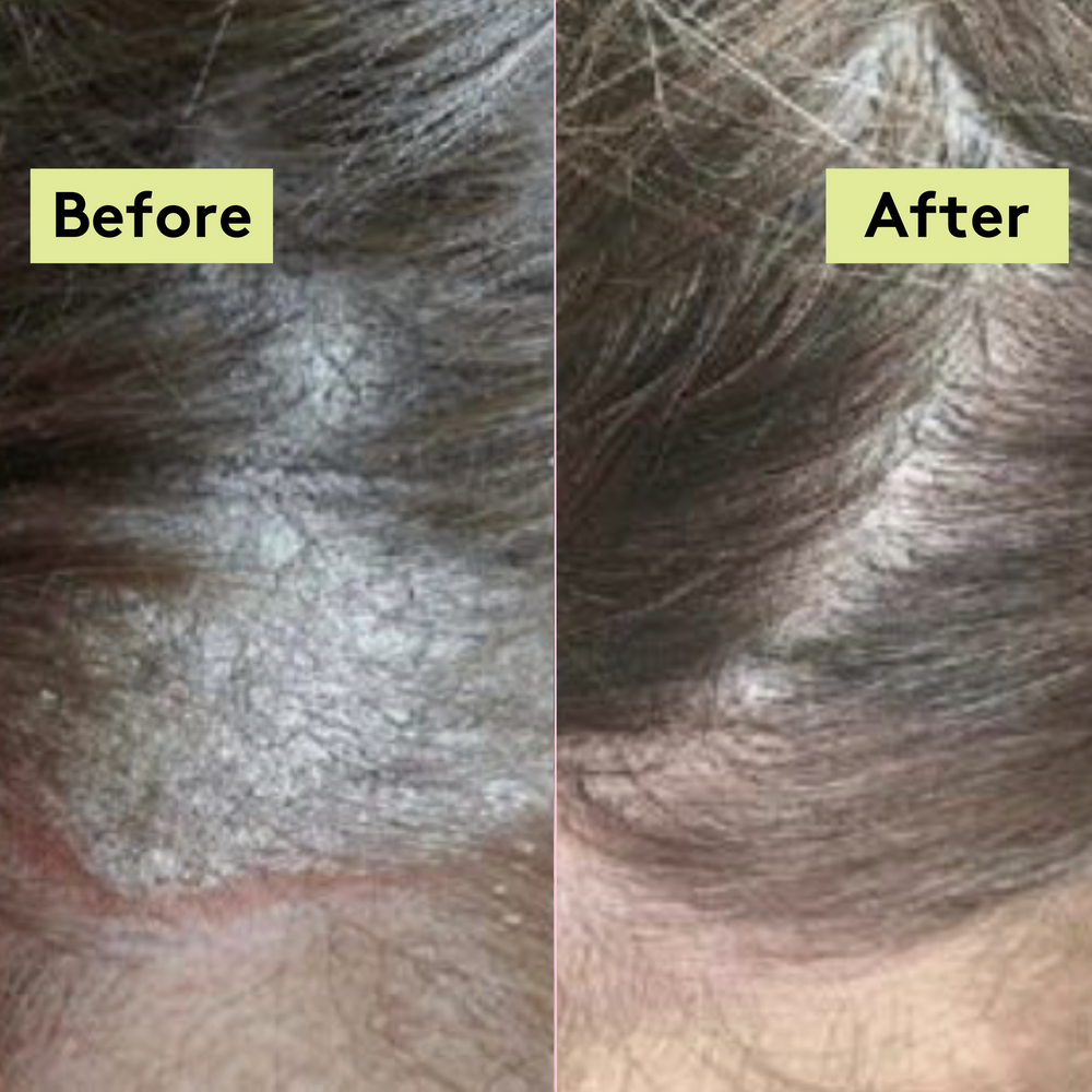 Scalp-Eaze Scalp Balm