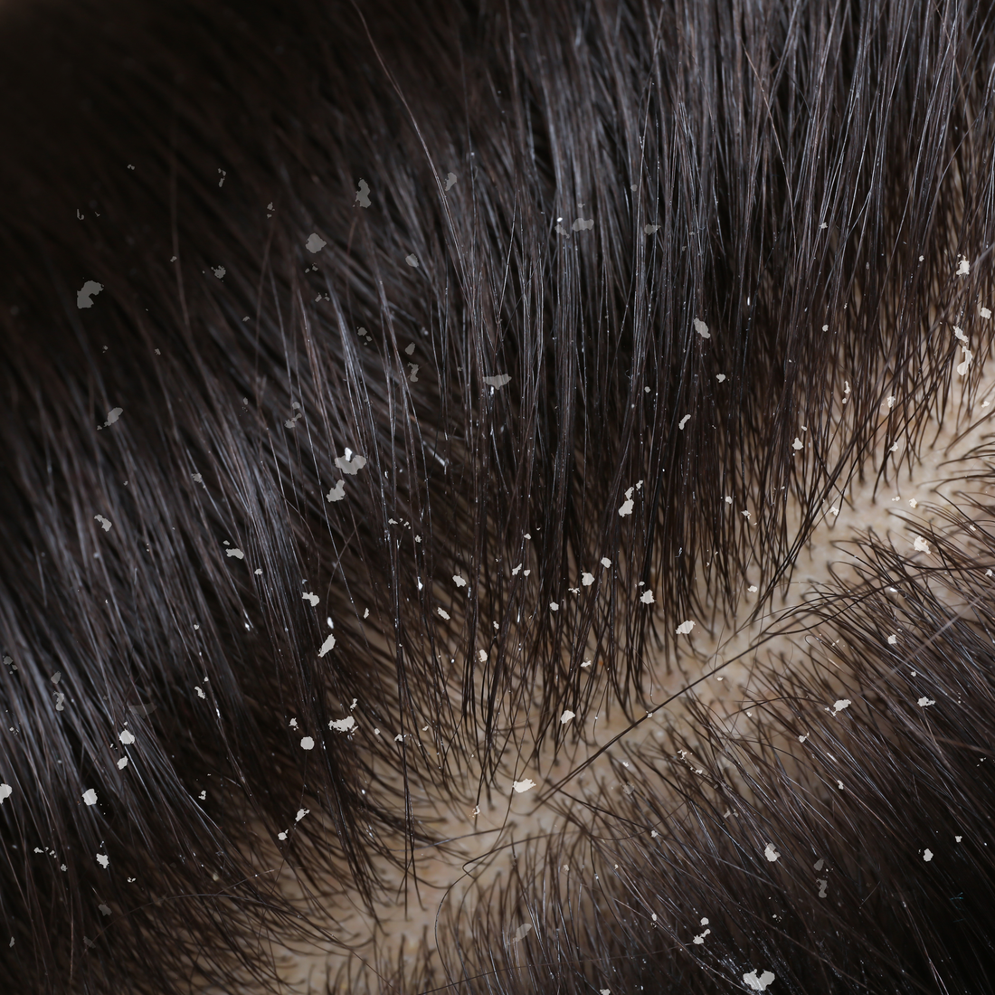 Do I Have Dandruff or a Dry Scalp?