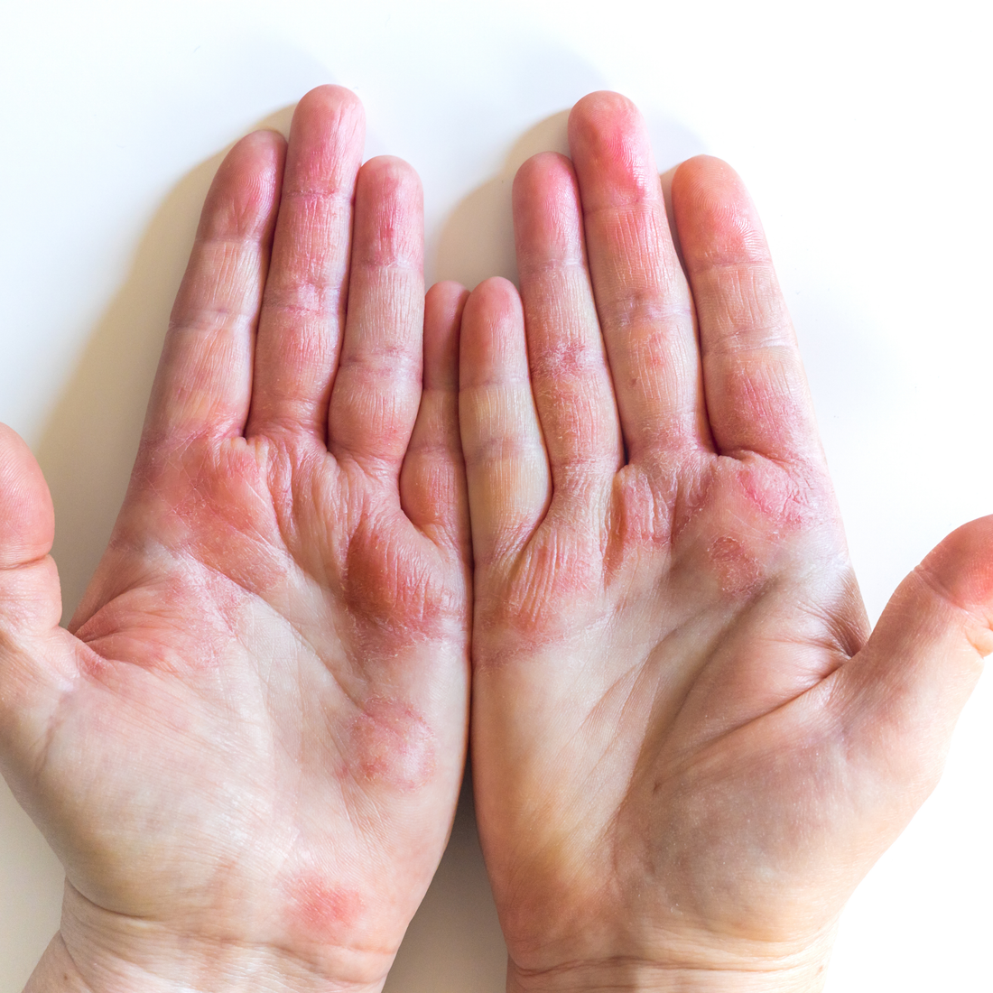 Beyond the Itch: A Holistic Guide to Eczema Relief