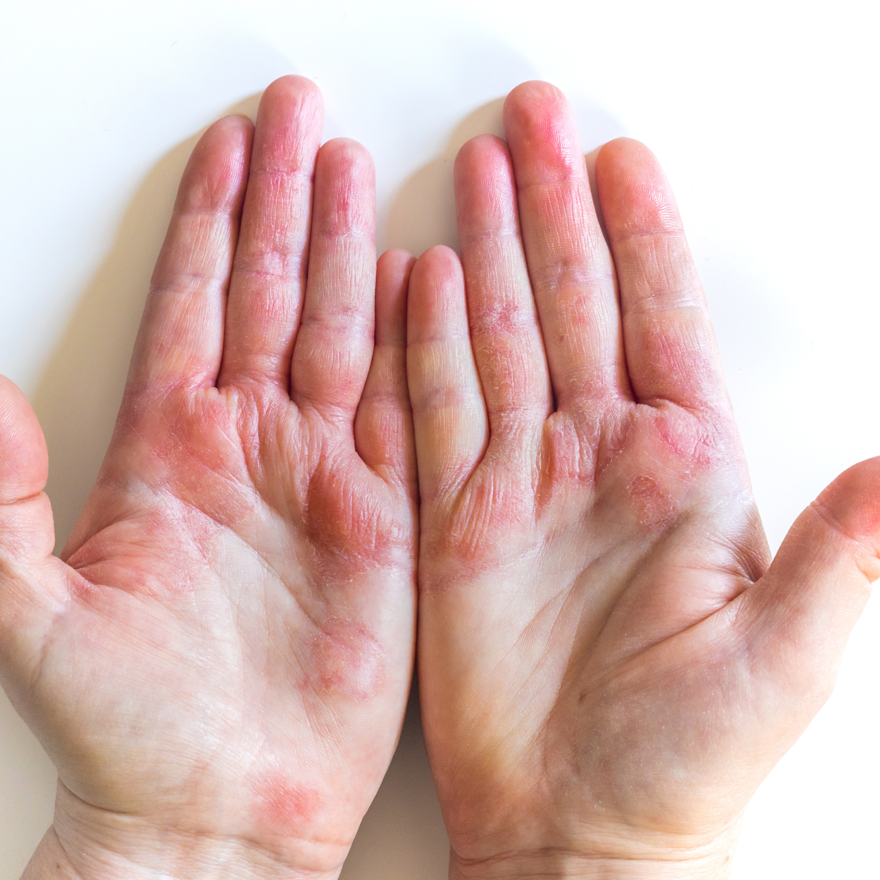 Beyond the Itch: A Holistic Guide to Eczema Relief
