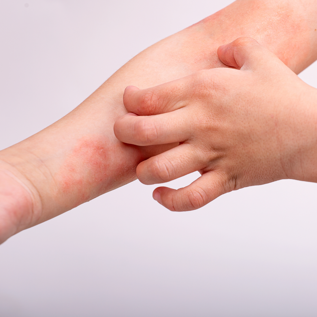 World Atopic Eczema Day: Understanding Eczema and How to Support Your Skin