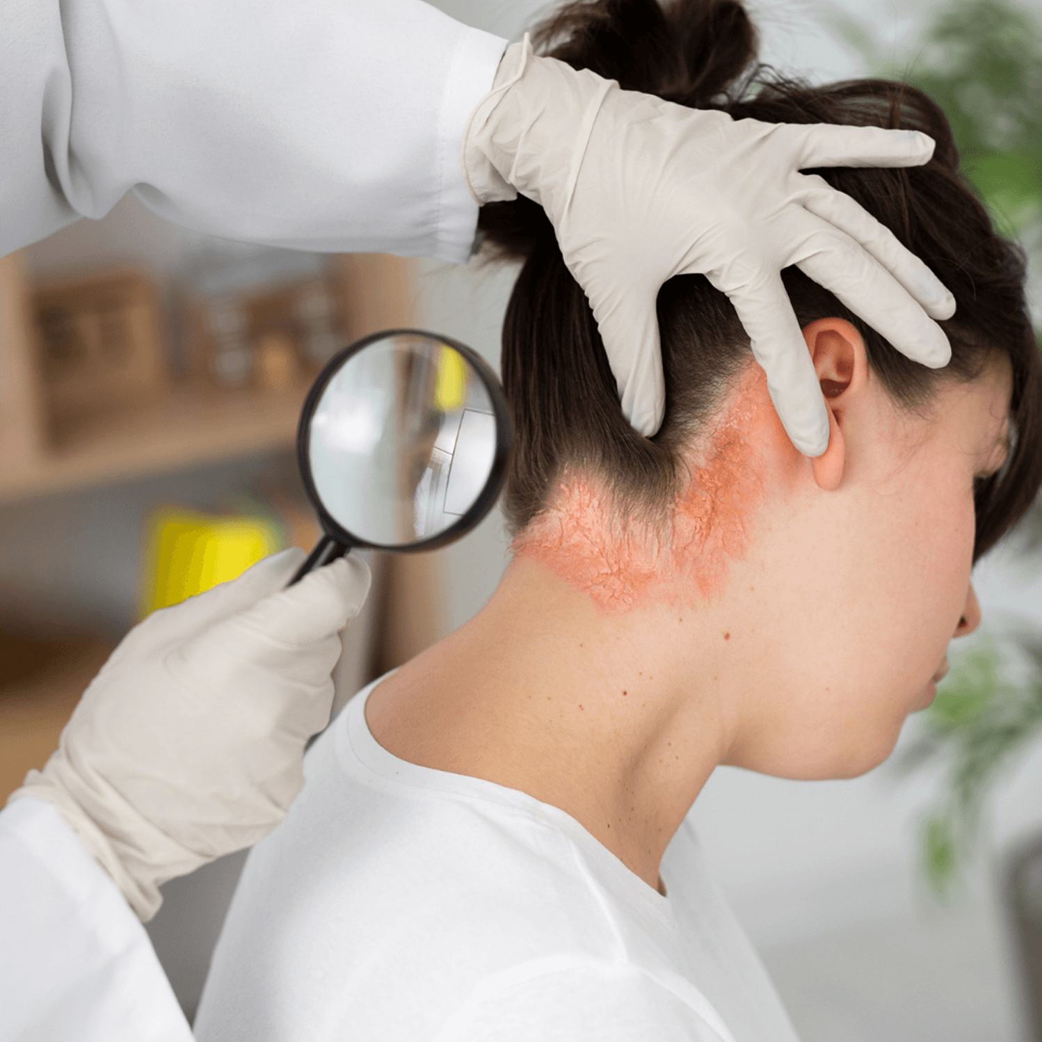 Scalp Psoriasis Treatment: Effective Ways to Reduce Flaking and Itching