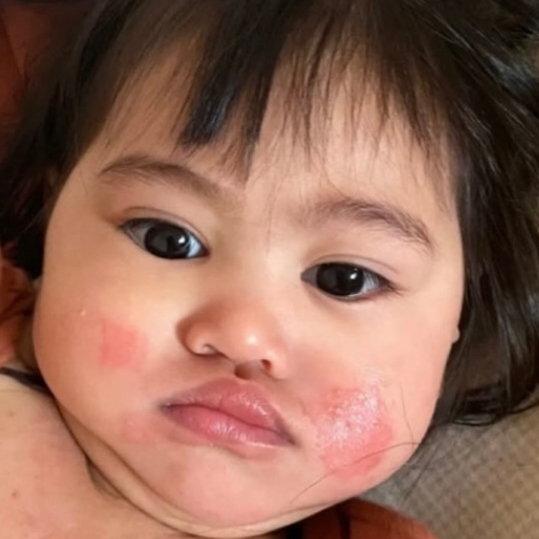 Does my baby have eczema?