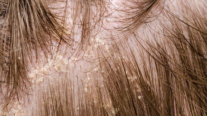 Scalp Eczema: All The Facts You Need To Know And How To Control It.