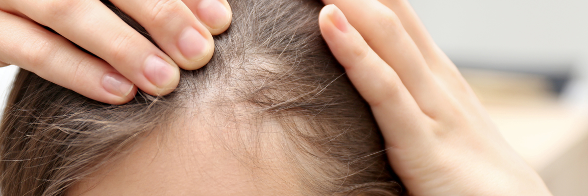 Hair Loss