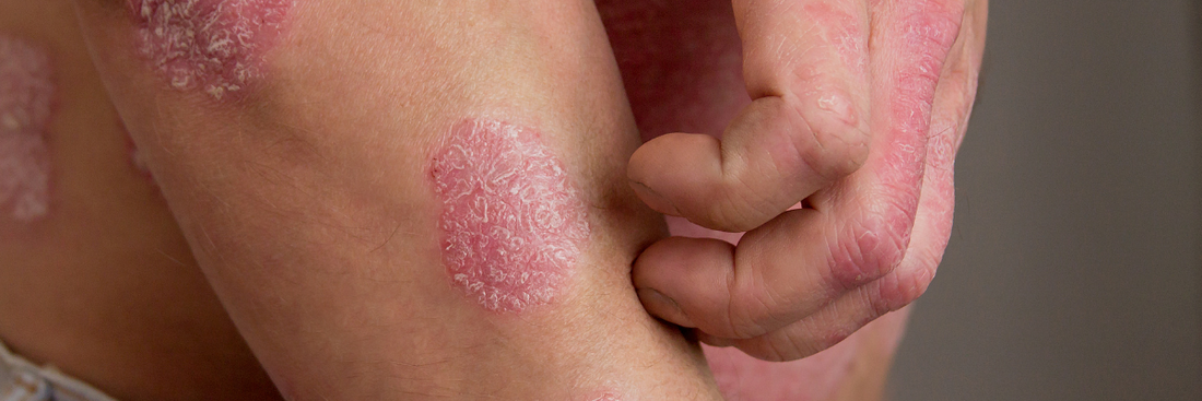 Psoriasis prone