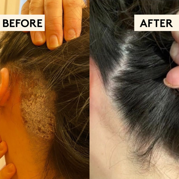 Hair & Scalp Saviour Set