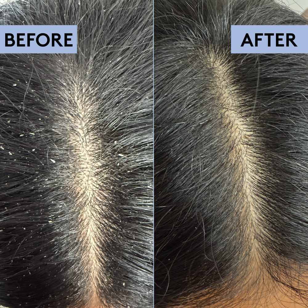 Scalp Psoriasis Relief Kit