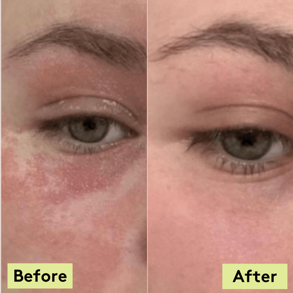 Should I Exfoliate My Psoriasis? 5 Skin Survival Tips For Psoriasis Wa