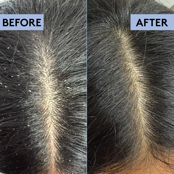 Scalp-Eaze Scalp Scrub