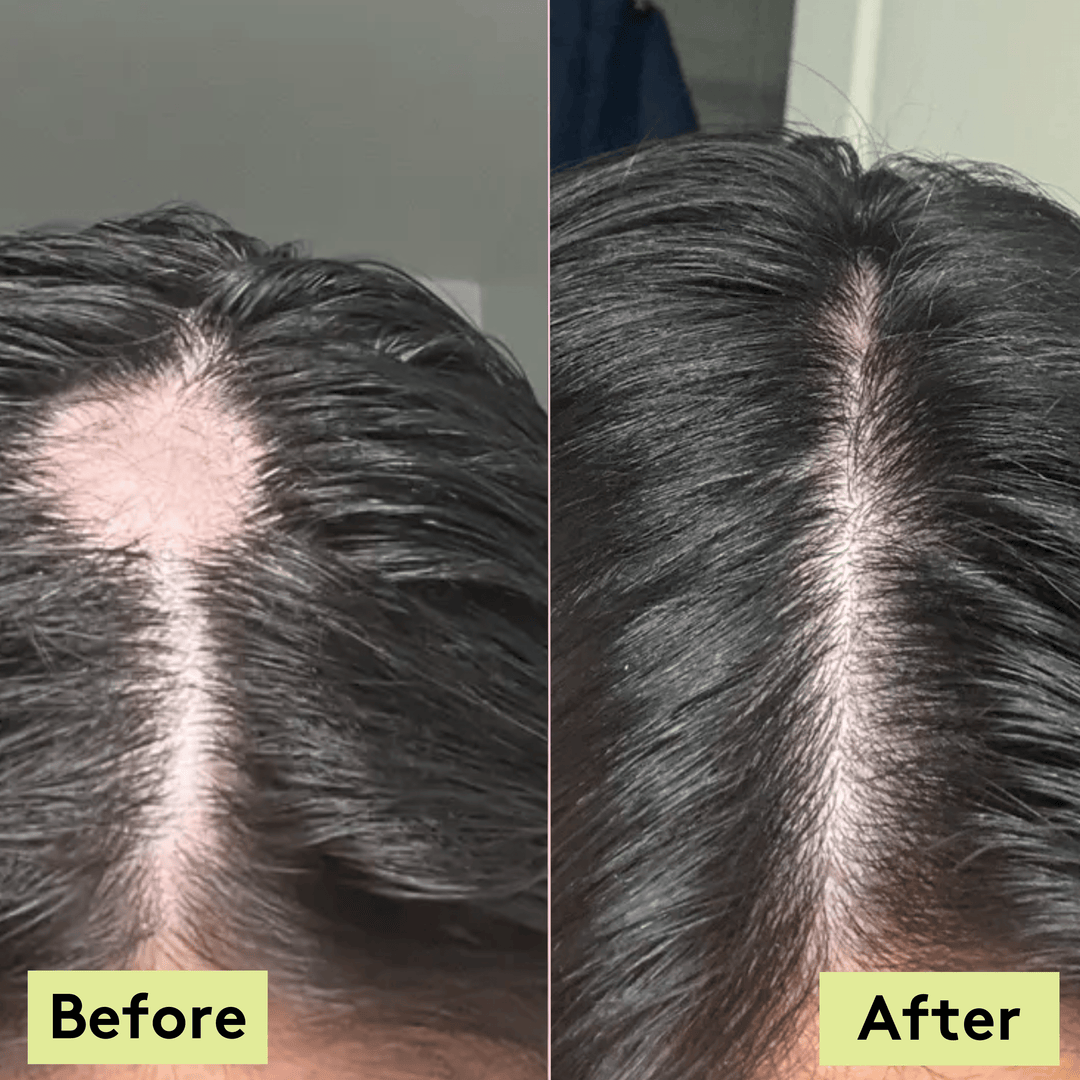 A person applying scalp oil